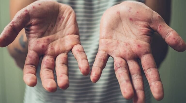 вірус коксакі